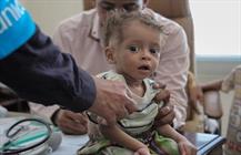 سوء تغذیه کودکان یمنی