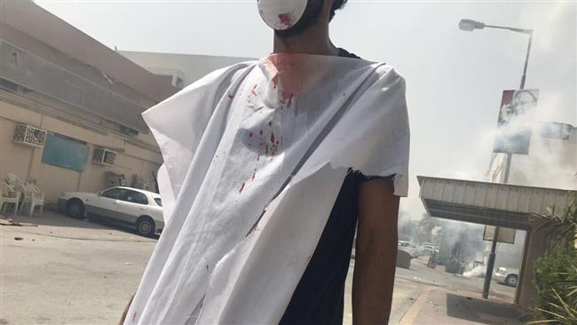 A picture posted on Twitter shows a protester injured during clashes with security forces in the northwestern Bahraini village of Diraz on May 23, 2017.