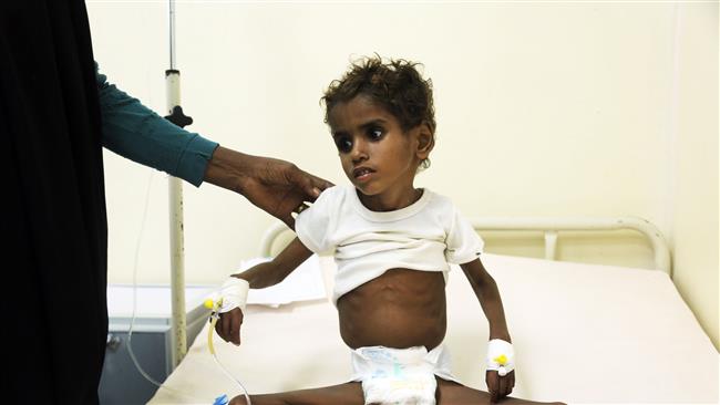 This photo taken on November 05, 2017 shows a malnourished Yemeni child receiving treatment at a hospital in the Yemeni port city of Hudaydah. (Photo by AFP)