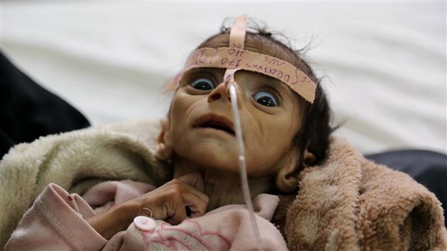 A Yemeni infant suffering from acute malnutrition, who died on March 24, is hospitalized at a hospital in Sana’a on March 22, 2016. (AP Photo)
