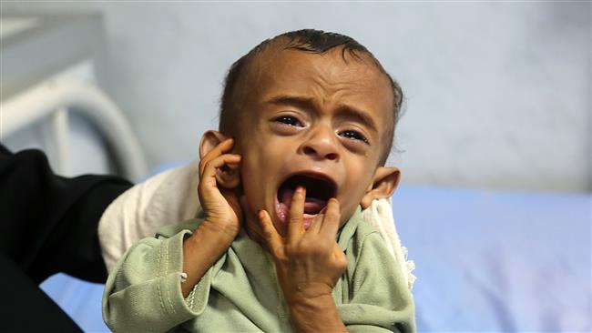 A malnourished Yemeni child receives treatment at a hospital in the Yemeni port city of Hudaydah on January 16, 2018.