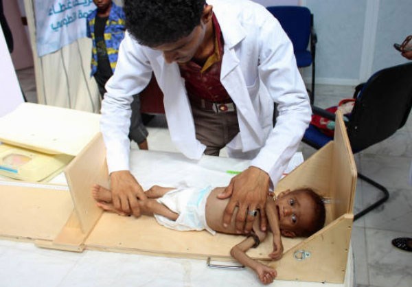 Yemeni Malnourished Children