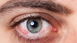 عدم درمان 6 نوع عفونت چشمی باعث آسیب جدی می شود