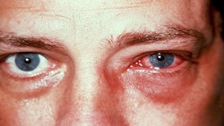 خطر سرماخوردگی برای چشم ها