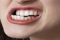 تهدیدات دندان قروچه برای دندانهایتان