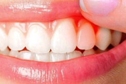 درمان عقب نشینی لثه از روی دندان