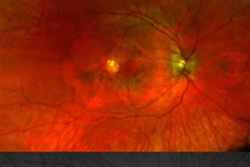 شناسایی بیماری ژنتیکی جدید در چشم