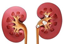 ایران روی کمربند سنگ کلیه قرار دارد/ توصیه‌ای به مردان بالای ۵۰ سال