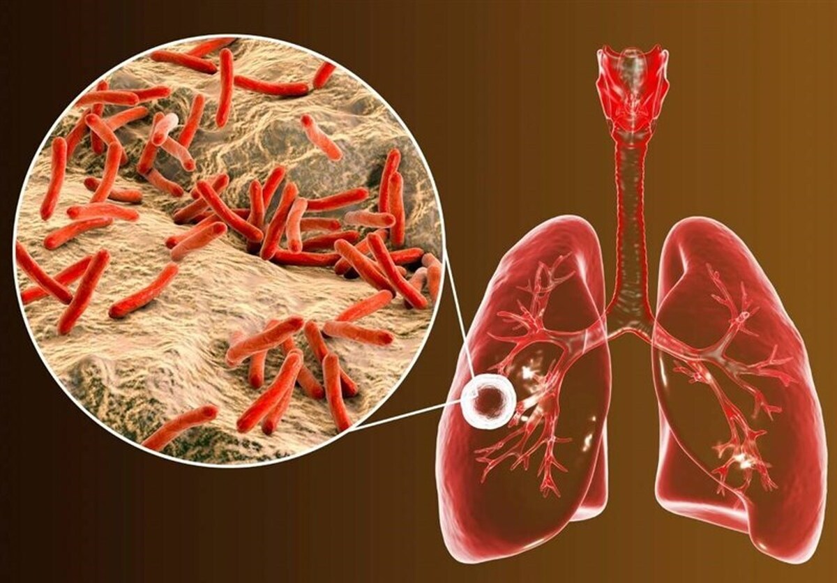 ابتلای ۶۵۰۰ نفر به بیماری