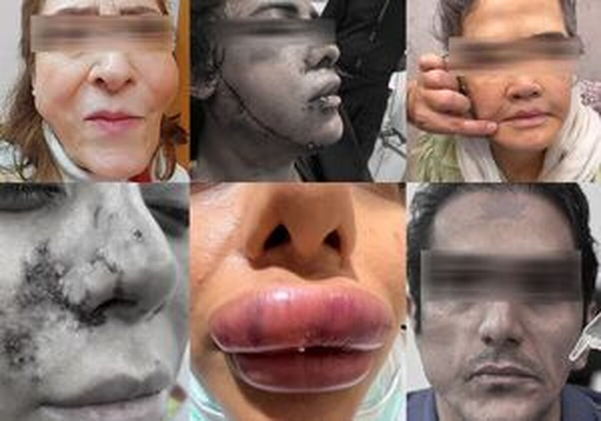 شیوع عوارض عفونی ناشی از لیفت چربی به صورت/ صورت بالشتیها بخوانند