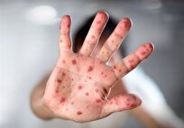 تأیید رسمی حذف سرخک و سرخجه در ایران توسط سازمان جهانی بهداشت